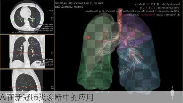 AI在新冠肺炎诊断中的应用